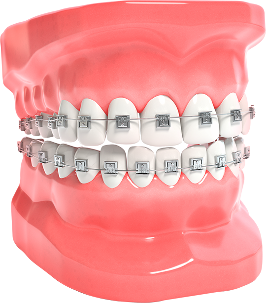 Metallic Braces