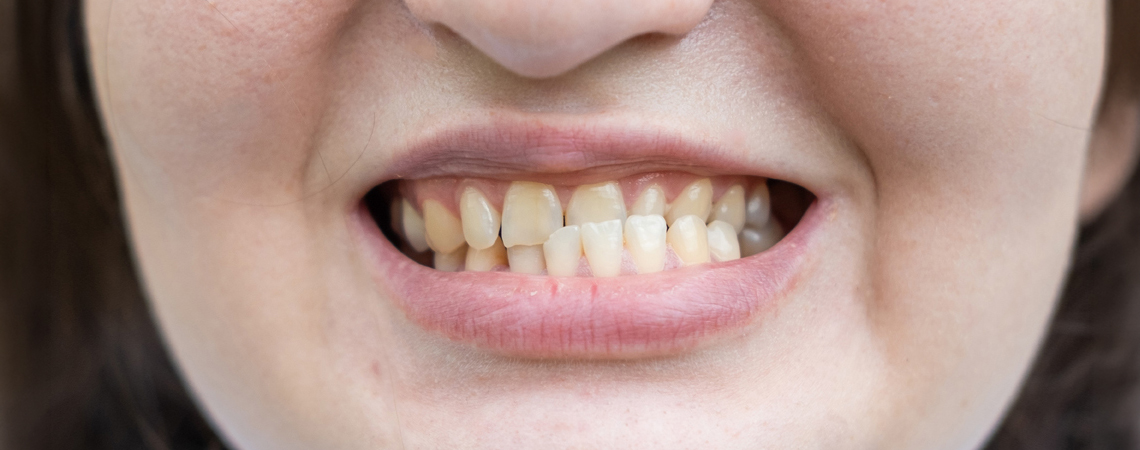 Close-up of crowded and overlapping front teeth, showing dental misalignment