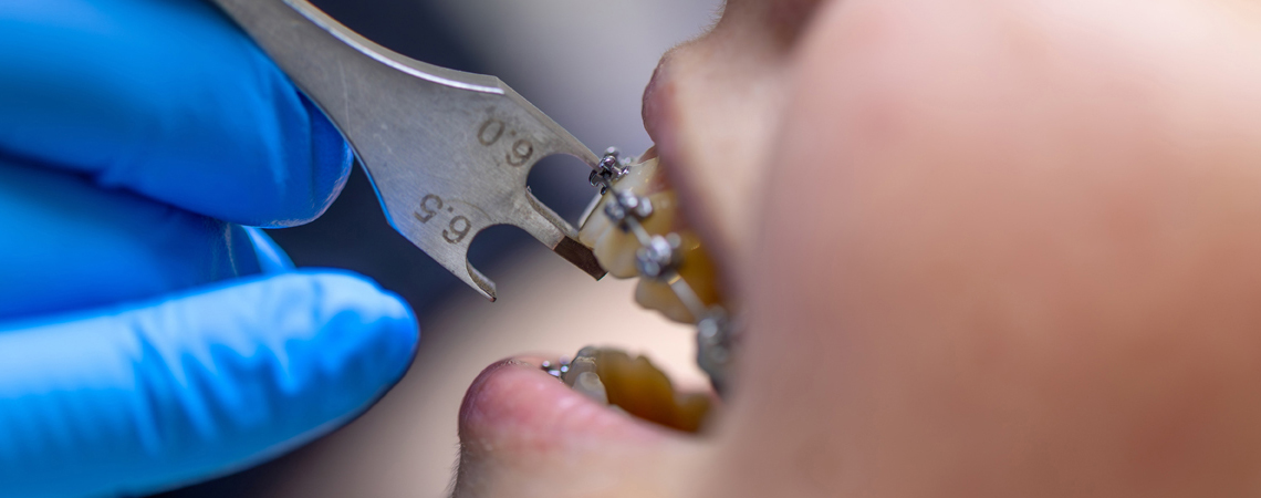 Dentist installing Damon braces.