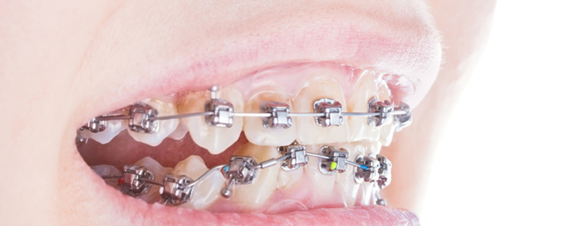 Damon braces on misaligned teeth.