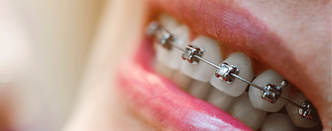 Close-up of self-litigating braces