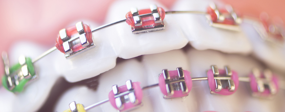 A set of colourful traditional metal braces.