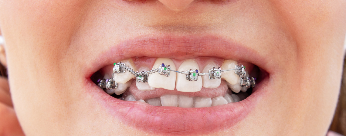Unlike other types of braces, traditional metal braces can correct even heavily misaligned teeth.