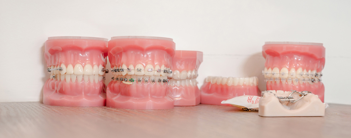 Dental models of various orthodontic appliances used to align teeth misalignment