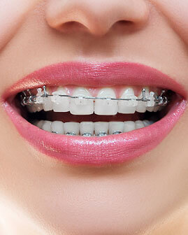 Braces Up - INSIDE 2014