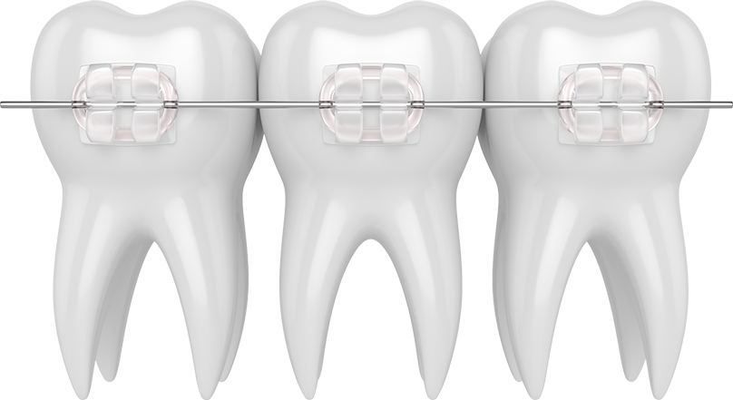 Ceramic Braces