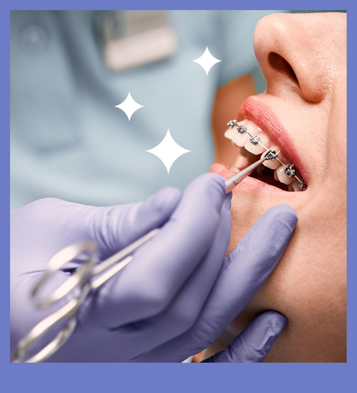 Cost of Metal Braces in Singapore