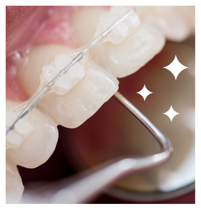How Ceramic Braces Treatment Works