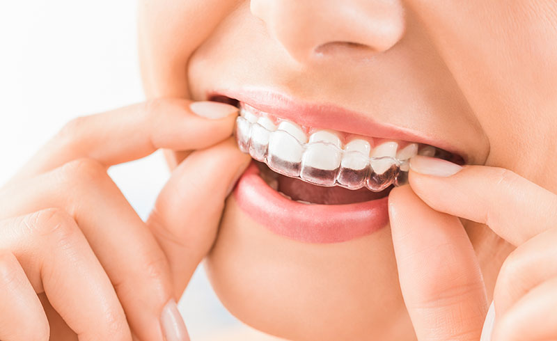 Invisible Braces Singapore – Invisalign