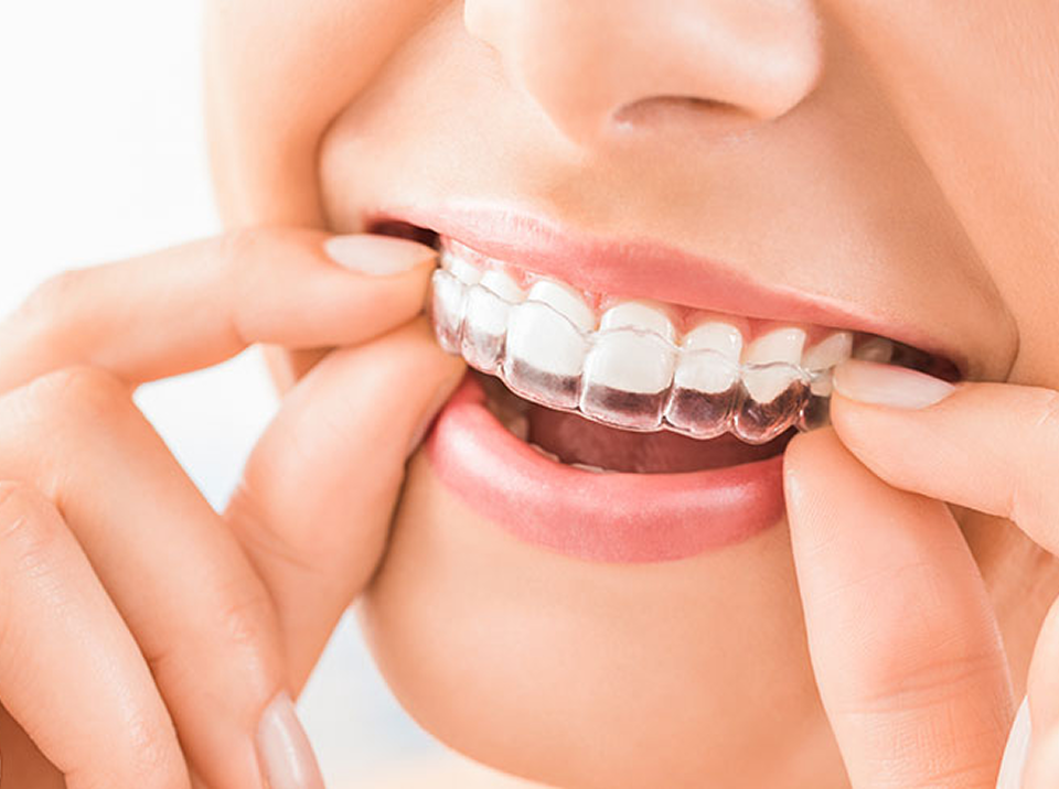 Person inserting an Invisalign aligner