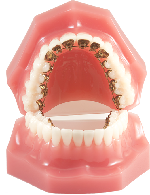 Lingual Braces