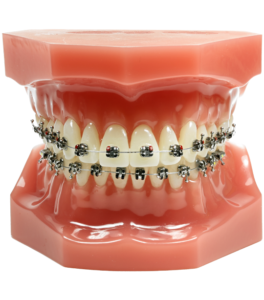Metal Braces Singapore