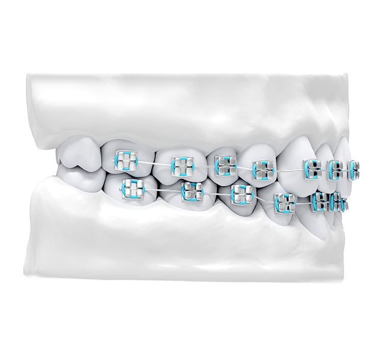 Orthodontic Braces Treatment