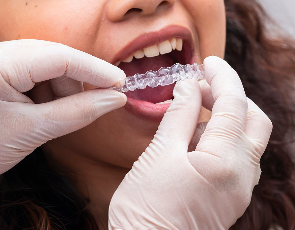 Orthodontist fitting an Invisalign aligner